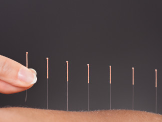 Person recieving acupuncture treatment